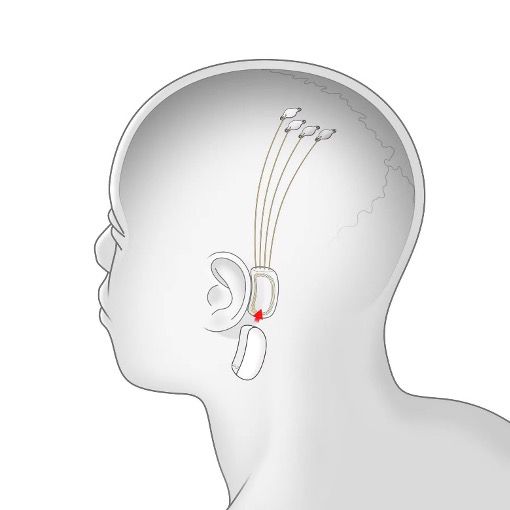 Neuralink2019年发布的第一个脑机接口效果图